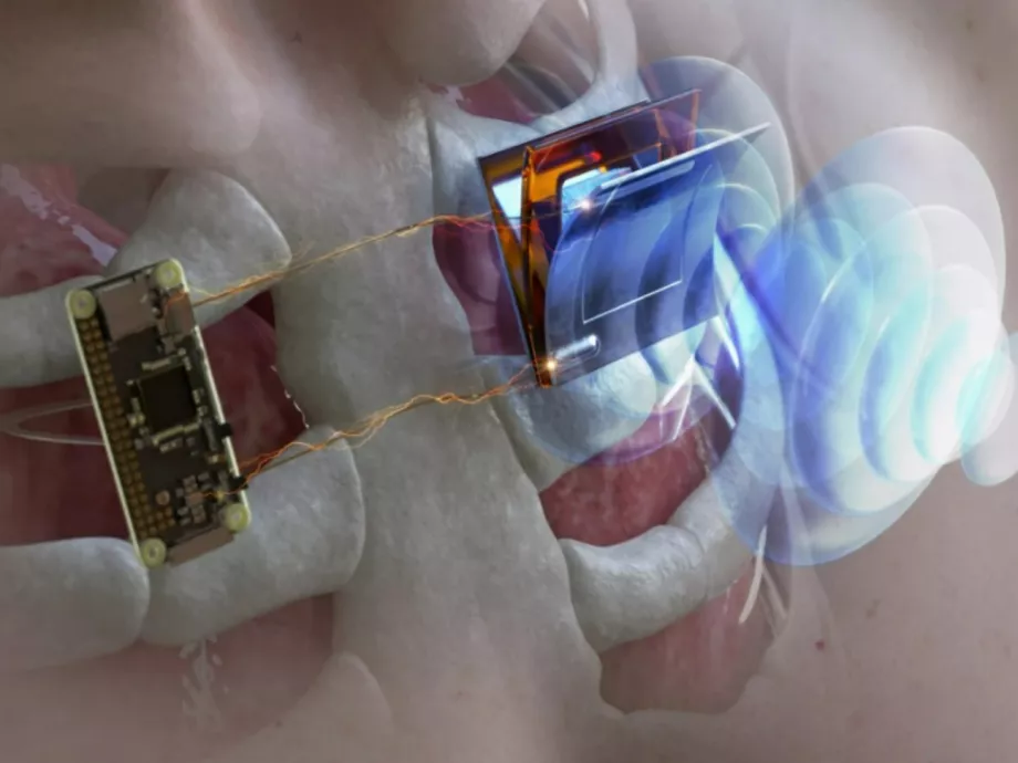 Pacemaker feltöltése kívülről, ultrahanggal